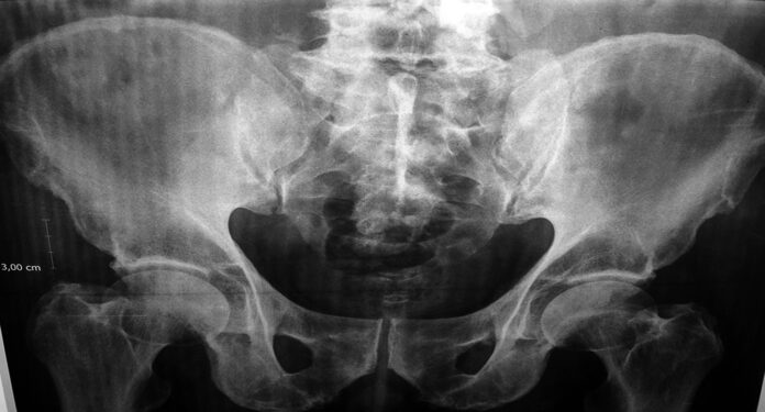 Los factores asociados a la salud de la zona pélvica son múltiples: embarazos, enfermedades crónicas, cirugías, estreñimiento, alcohol y tabaco, entre otros. Los factores asociados a la salud de la zona pélvica son múltiples: embarazos, enfermedades crónicas, cirugías, estreñimiento, alcohol y tabaco, entre otros.